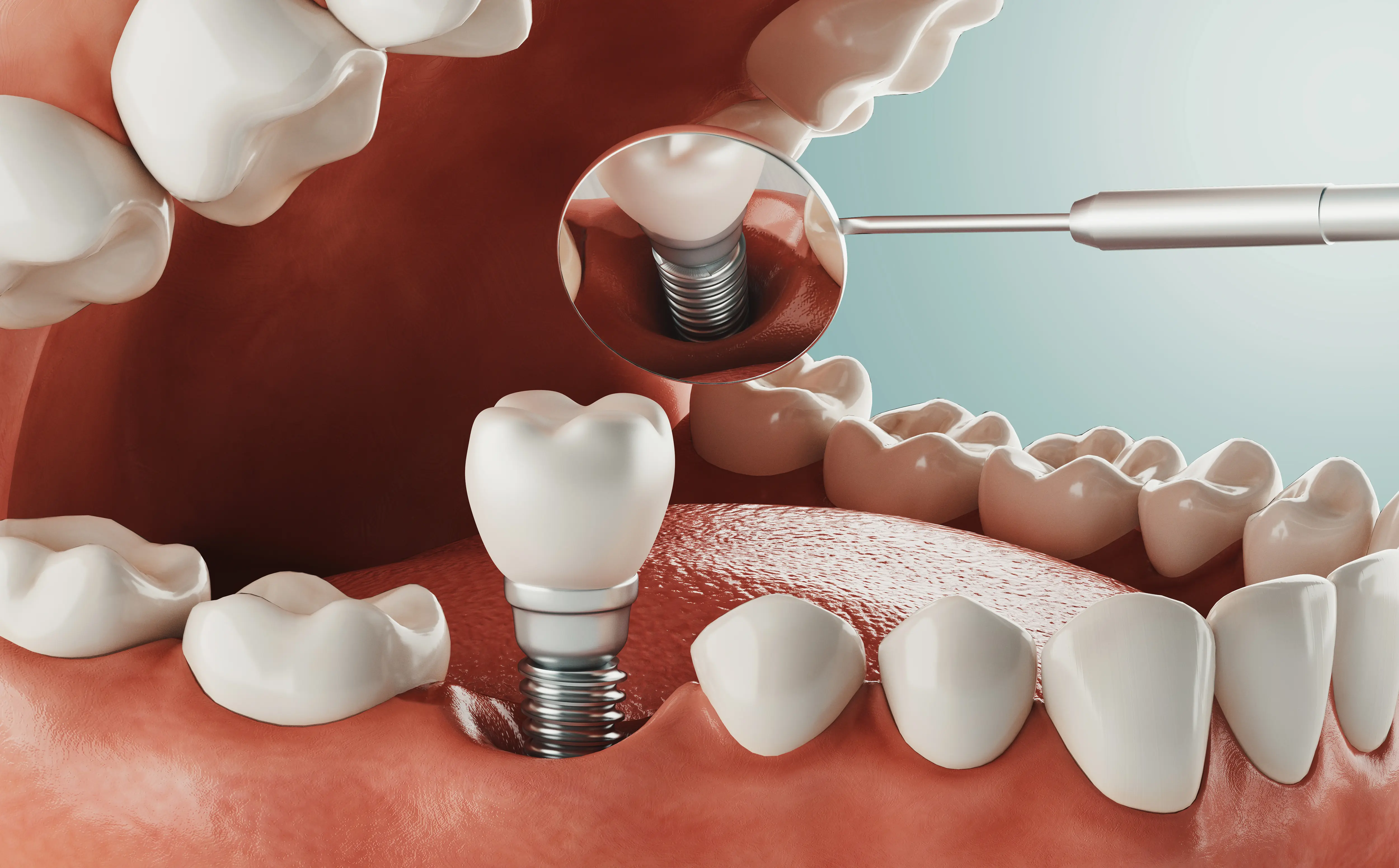 Dental implant smile