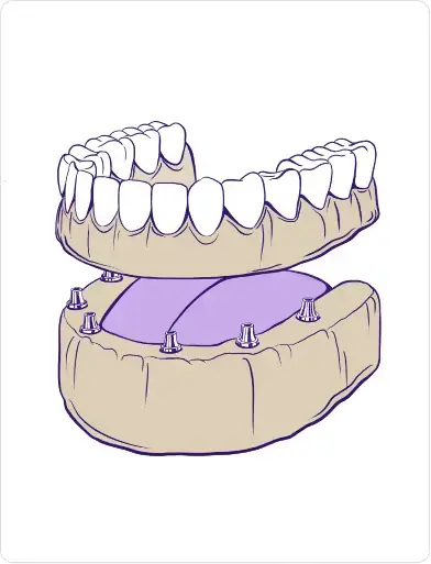 Full-mouth dental implants