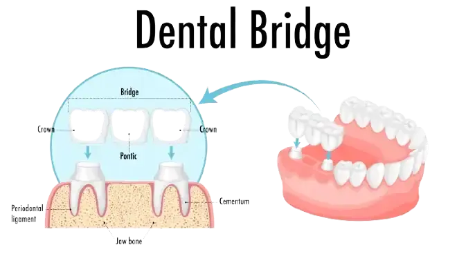 Dental implant smile