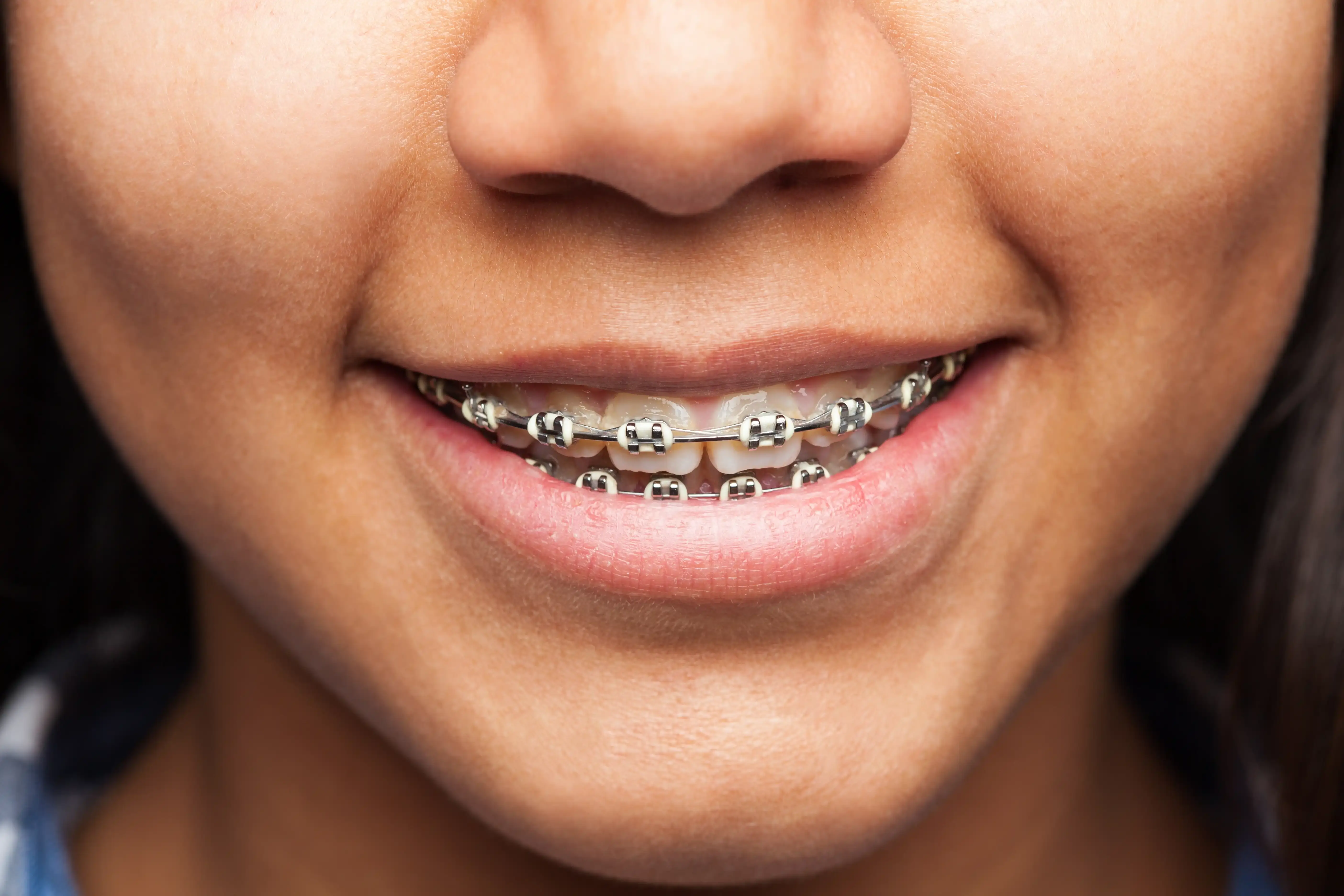 Metal Braces
