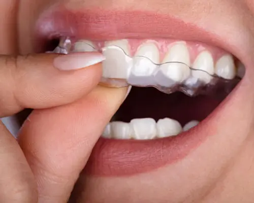 Dental implant visualization