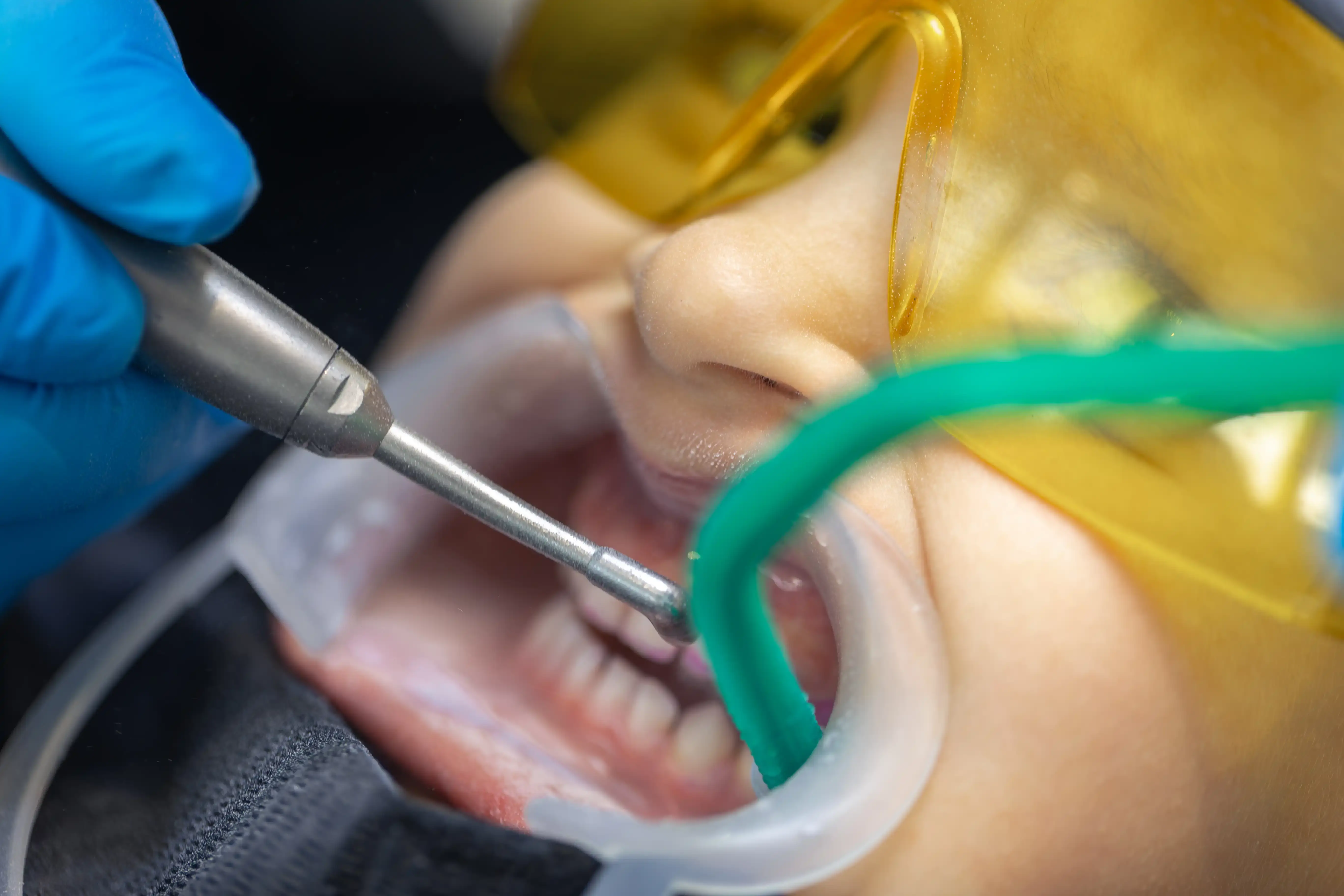 Dental implant visualization