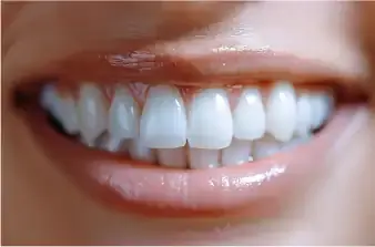 After - Smile Transformation 1 - From discolored teeth to bright white smile